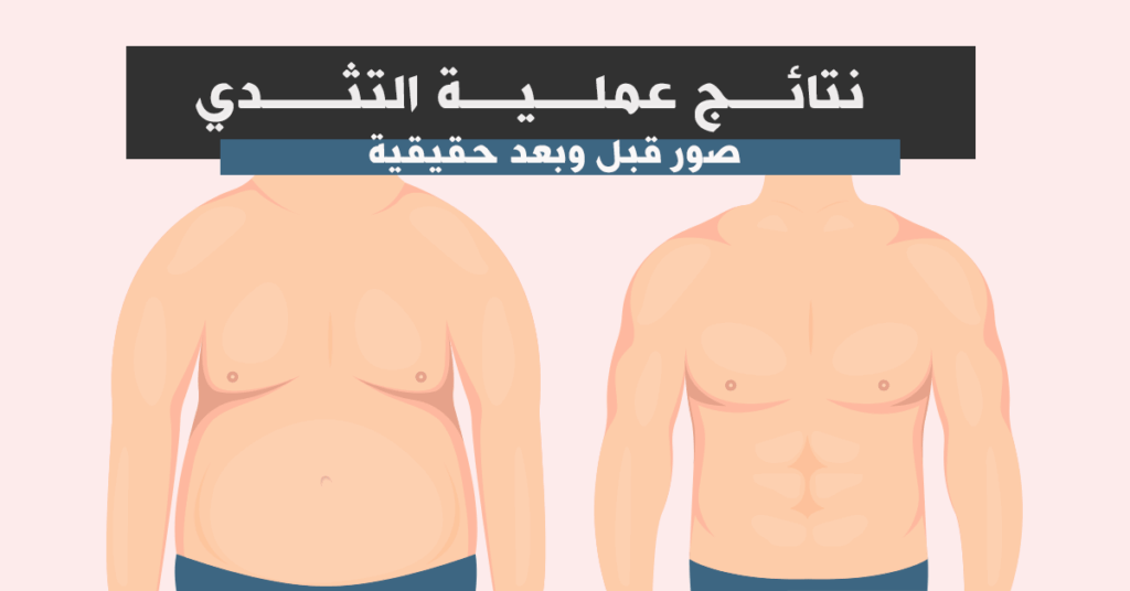 نتائج عملية التثدي قبل وبعد