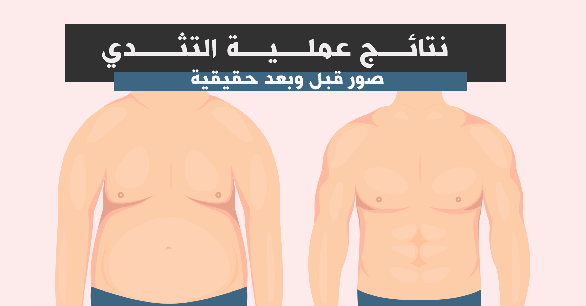 نتائج عملية التثدي قبل وبعد